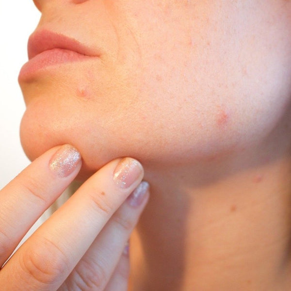 What is niacinamide?